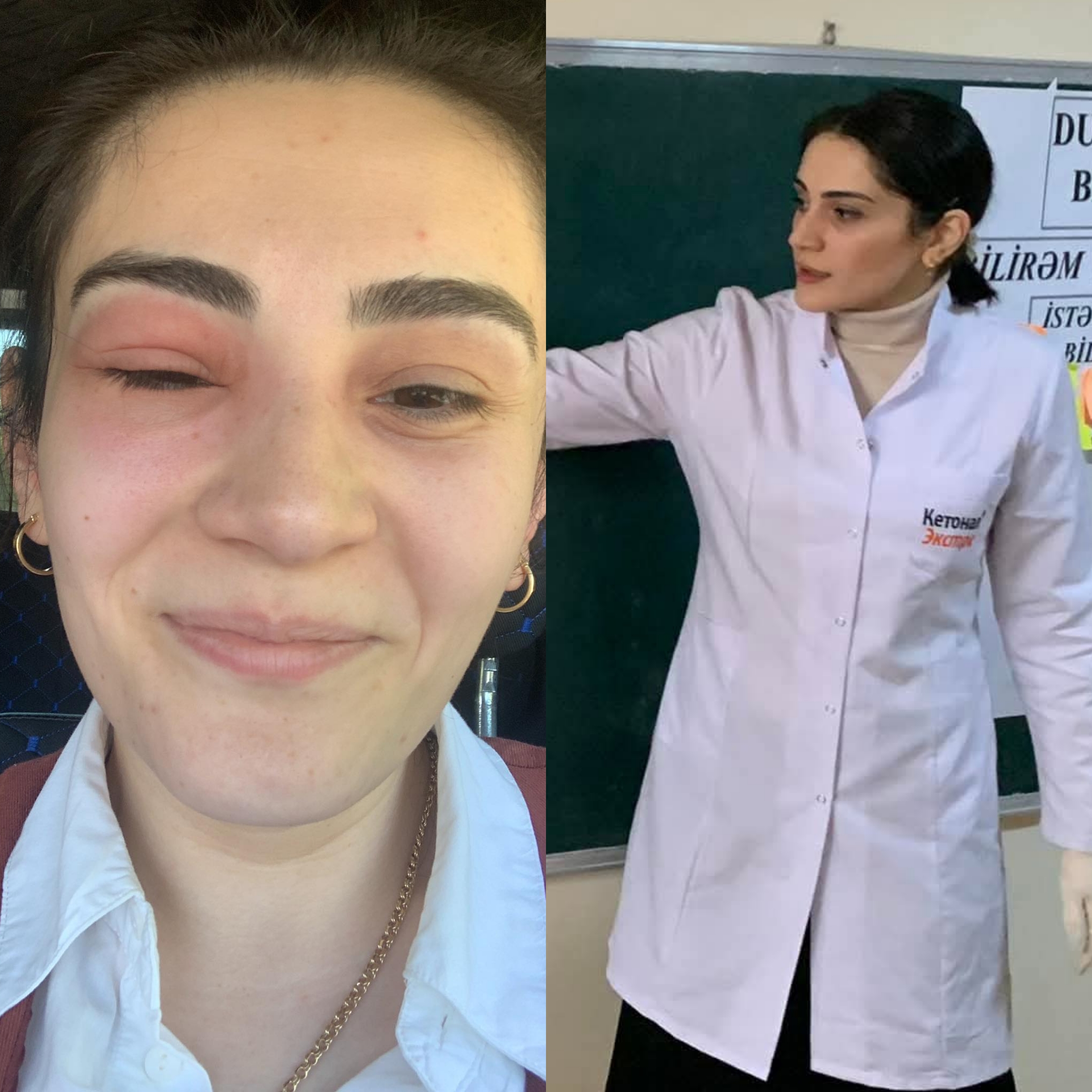 Gözünü arı sancan kimya müəllimi: “Tək gözlə 55 bal topladım” 